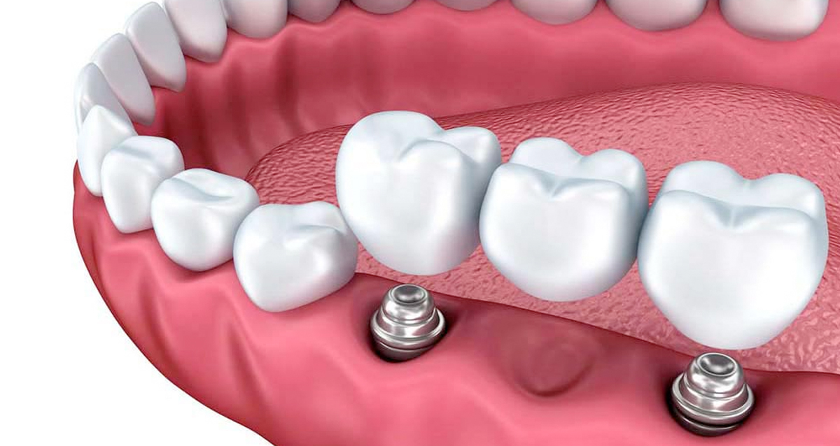 имплантация зубов мостовидный протез